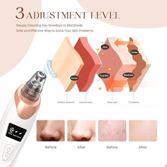 5 in 1 Blackhead Remover Vacuum